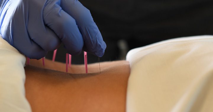 physical therapy applies dryneedling treatment at mercy health