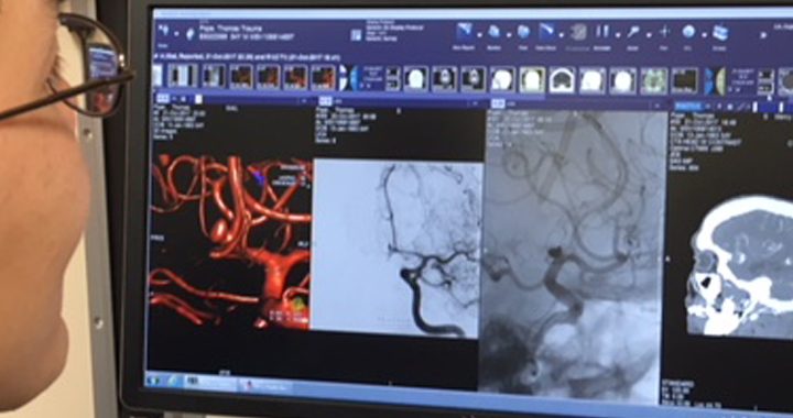 cerebral aneurysm recovery story